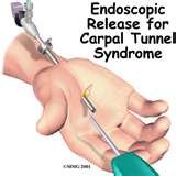 carpal tunnel.jpg